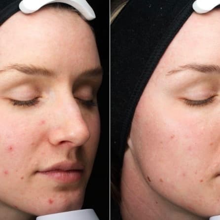 Chemical Peel: Acne - 3 Sessions at BE TRU BEAUTY SPA in Fairfield, CT